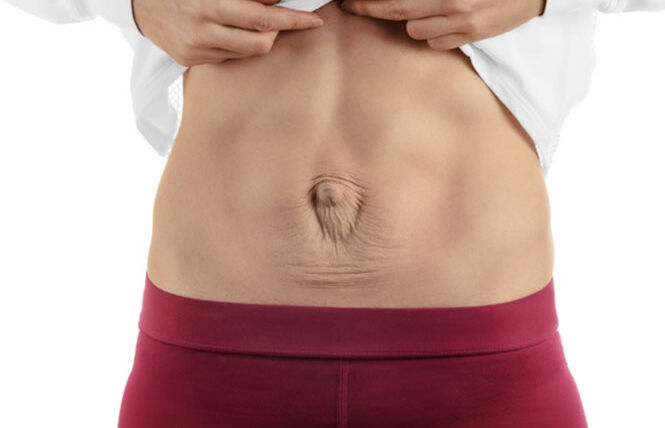 Diástase Abdominal